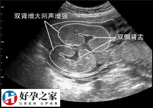 二维彩超上的3个数据看男女的技巧