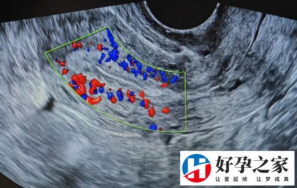 子宫内膜血流2级 子宫内膜血流2级