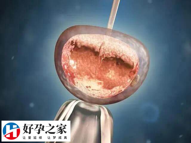 自然周期移植需满足哪些要求