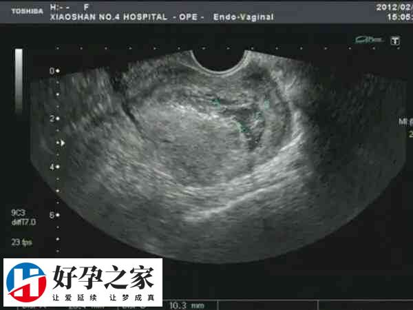 促排双胞胎需不需要减胎