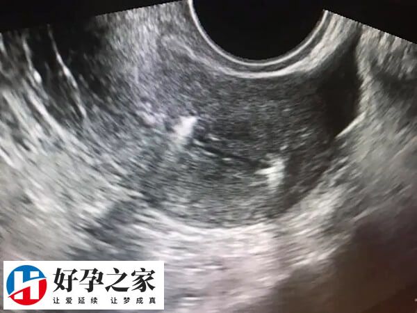 取卵后如何避免发生宫腔分离