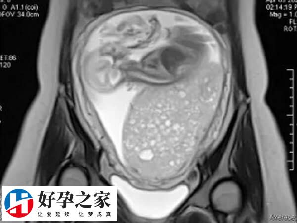 试管婴儿促排期间做b超的原因是什么